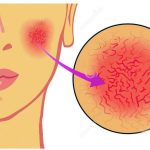 pag10_couperose-medical-illustration-symptoms-30466586