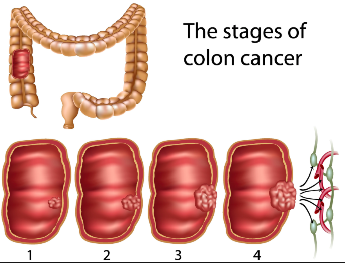 Sconvolgente: 4 casi di cancro al colon al giorno diagnosticati alle Canarie